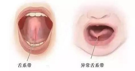 舌系帶過長影響孩子發音,嚴重不會說話